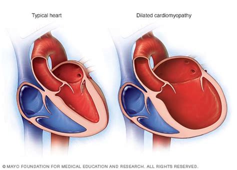 mild lv dilation|does dilated cardiomyopathy go away.